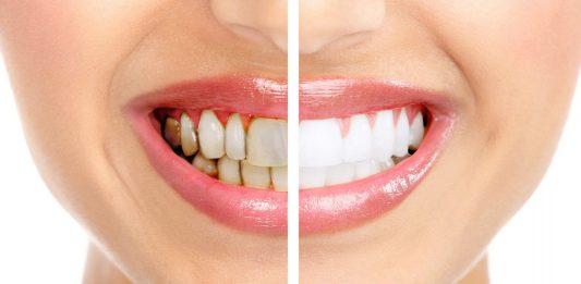Chăm sóc răng miệng đúng cách: 10 người chỉ 1 người làm chuẩn